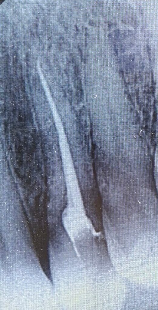 root canal treatment