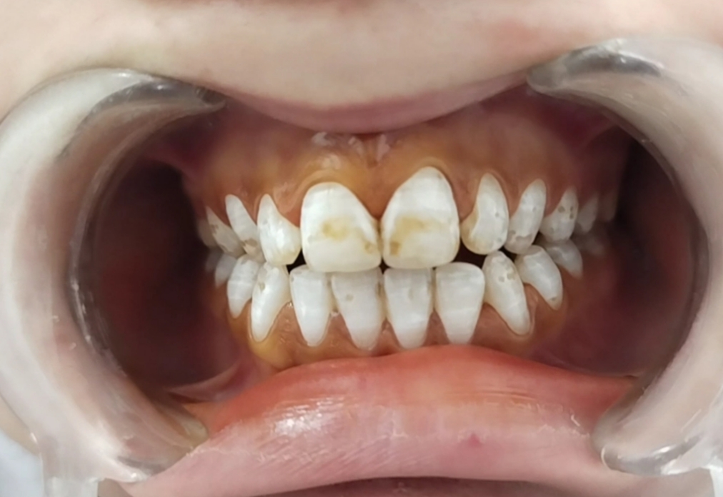 Shedding Light on Dental Fluorosis: A Personal Journey Through Community Challenges and Solutions - Illustration representing dental fluorosis awareness, patient treatment journey, community challenges, and proactive solutions.