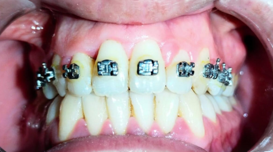 after orthodontic braces