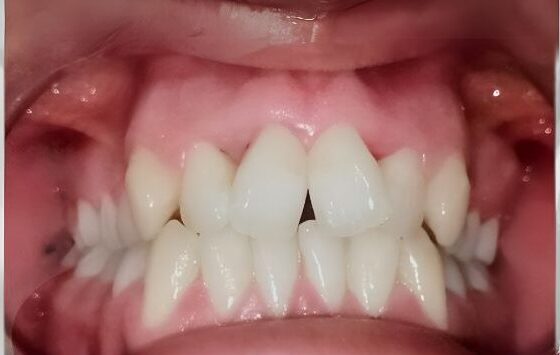 before orthodontic braces