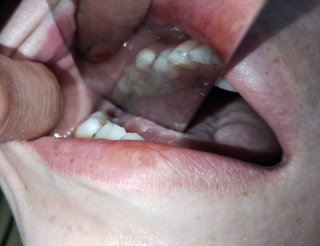tooth fragment extraction
