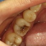 root canal treatment case
