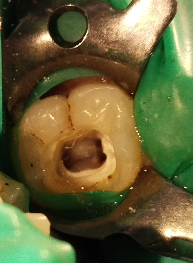 canals inside the tooth