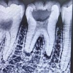 root canal radiograph